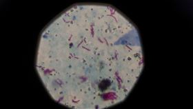 世界衛生組織29日發布報告指出，結核病在2023年取代COVID-19成為傳染性疾病相關死亡案例中的首要原因。圖為從顯微鏡中看到的結核病陽性樣本。（圖／路透社／達志影像）
