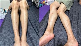入住一晚6600元！阿里山民宿「夫妻被跳蚤咬到毀容」崩潰　萬人一看驚呆　翻攝自爆料公社臉書