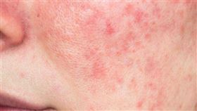 滿臉紅色膿包可能是酒糟肌！醫分享7大護膚秘招改善泛紅（圖／姊妹淘）