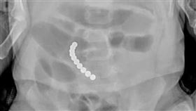 ▲家長要小心避免孩童誤吞巴克球。（圖／翻攝自來講兒科急診的543-吳昌騰醫師粉專）