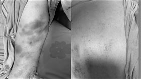 阿嬤遭移工施暴，全身瘀青。（圖／翻攝自Dcard）