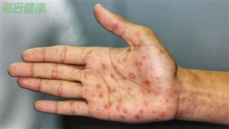 流感、腸病毒症狀差在哪？「3關鍵」辨別