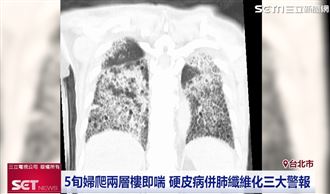 小心肺纖維化找上門 醫授這招及早戒備