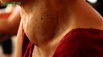 脖子變黑、變粗？小心隱藏「3大健康危機」　醫示警：恐糖尿病前期