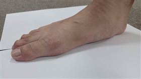 誤穿足弓鞋，矯正扁平足 導致足底筋膜炎，童綜合醫院骨科部王叔昂醫師(圖／翻攝畫面)