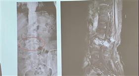 患者因跌倒後雙腳無力疼痛就醫，醫師發現腰椎骨折外另有腫瘤壓迫，進一步檢查發現乳癌癌細胞轉移。（圖／翻攝自衛生福利部臺中醫院）
