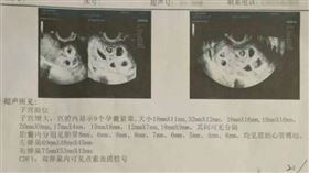 大陸江西省南昌市1名25歲侯姓女子近日到醫院進行產檢，沒想到結果顯示宮腔內有9個孕囊緊靠。（圖／翻攝自瀟湘晨報）