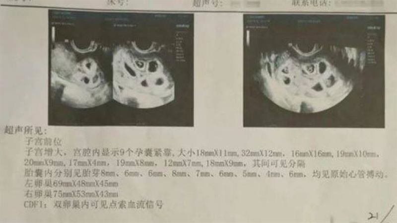 女結婚1年沒懷孕　打排卵針產檢驚見9胞胎