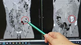 健身男，腹痛，吃不下，查出極少見惡性肉瘤，骨外骨肉瘤，光田綜合醫院大腸直腸外科佘冠旻(圖／翻攝畫面)