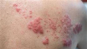 83歲糖友染皮蛇「右手肌肉竟萎縮」　醫籲接種4大疫苗預防