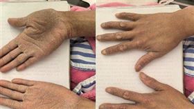 35歲女吞中藥治便祕　3年後竟「全身發黑」！醫一查驚：砒霜中毒