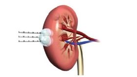 男大生得腎臟癌(台中醫院提供)