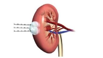 改用1油品 她腎功能大躍進！血脂也正常了