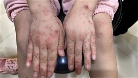 台中1名5歲女童因感染腸病毒手足口病，四肢狂冒水泡，連妹妹都感染。（圖／施勝桓醫師提供）