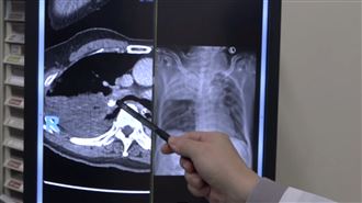 假牙掉支氣管卡住！59歲男發高燒住進ICU