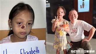 女童臉裂乒乓球洞　台灣醫暖幫她縫起來了