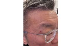 蔡其昌，世界12強,被冠軍獎盃砸傷，眼角流血，是冠軍烙印，歷史性傷口(圖／翻攝自蔡其昌Treads)