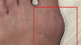 瘋12強 ，球賽，灌啤酒、吃炸物 痛風石破裂流白沙(圖／亞大醫院提供)