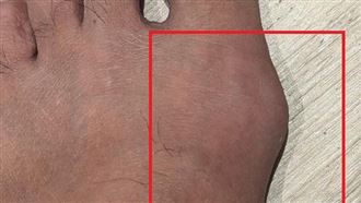 瘋12強棒球賽！男灌啤酒炸物腳長異物嚇傻