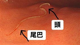 換找照胃鏡時發現「胃部有一條線」，原來是「海獸胃線蟲」。（圖／林相宏醫師授權提供）
