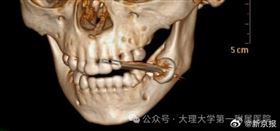 電池,爆炸,X光片(圖/翻攝微博)
