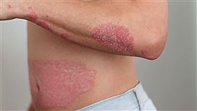 男子患乾癬20年不敢游泳！新口服標靶藥助患者重拾生活品質