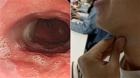 胃酸逆流好痛苦！男照胃鏡見「整片鮭魚色」　醫一看：癌前病變（組合圖／資料照，張靖醫師授權提供）