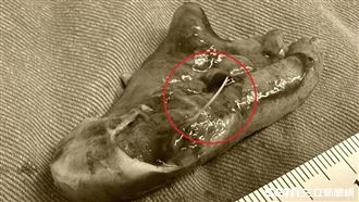 開闌尾手術驚見魚骨　男：前幾天的白帶魚