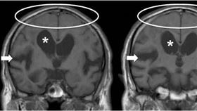 水腦症（安南醫院提供）