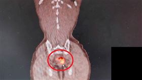 經正子造影檢查，確認張先生沒有轉移，因此安排手術切除腫瘤。(紅圈處為惡性腫瘤)。（圖／大千綜合醫院提供）