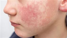 日本爆發「蘋果病」疫情！ 「巴掌印」症狀後期才會出現？ 專家籲做3件事預防(圖／潮健康)