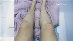 控吃連鎖壽司全身紅疹! 業者:就醫結果無直接關聯