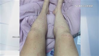 控吃連鎖壽司全身紅疹！業者：無直接關聯