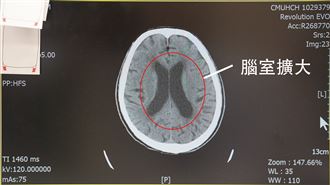 不是失智！他記性差竟罹水腦症 小心5變化