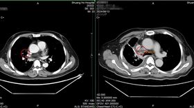 從賴先生8月（圖右）與11月（圖左）胸部電腦斷層影像來看，可發現原2.68cm的腫瘤（紅圈處）明顯縮小。（圖／雙和醫院提供）