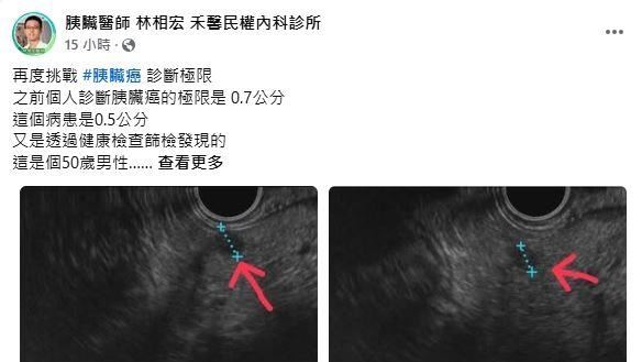 中年男「不菸不酒」健檢竟現2超迷你癌王