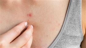 隆乳後胸口爆痘，網友悲喊「長輩」帶不出門！ 醫破解「密痘奶」3大主因