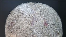 ▲頭皮型乾癬--頭皮病灶(治療前)--黃毓惠醫師提供