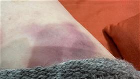 范雲曝光瘀青照（圖／范雲國會辦公室提供）