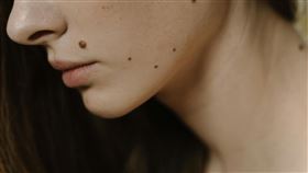 痣不只影響美觀，還可能對身體造成影響。（示意圖／翻攝自Pexels）