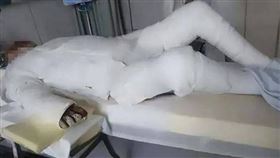 男大生全身90％燒傷，可能需要截肢。（圖／翻攝自微博）