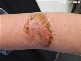 高3女忙學測癢到傷口苔癬化 醫：很多人有（圖／翻攝畫面）