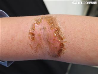 高3女忙學測癢到傷口苔癬化 醫：很多人有