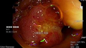 透過大腸鏡檢查，發現腫瘤已潰瘍且造成大腸狹窄。（圖／大千綜合醫院提供）