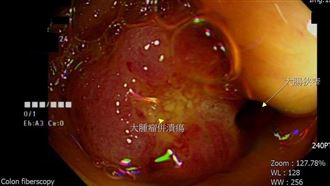 嚇！15歲少年竟罹大腸癌第四期 醫曝6徵兆