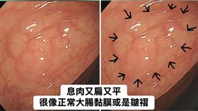 女子罹患鋸齒狀息肉症候群，大腸內出現20顆以上的息肉。（圖／翻攝自「胰臟醫師 林相宏 禾馨民權內科診所」臉書）