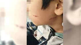 大陸四川一名14歲男學生遭同學賞巴掌、拿釘子燙臉。（圖／翻攝自微博／頭條新聞）