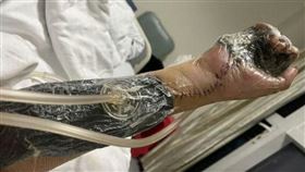 上班才6天，貴州男誤觸「輻射源」，右手萎縮腐爛，恐截肢，伽馬射線，金屬探傷(圖／翻攝自微博)