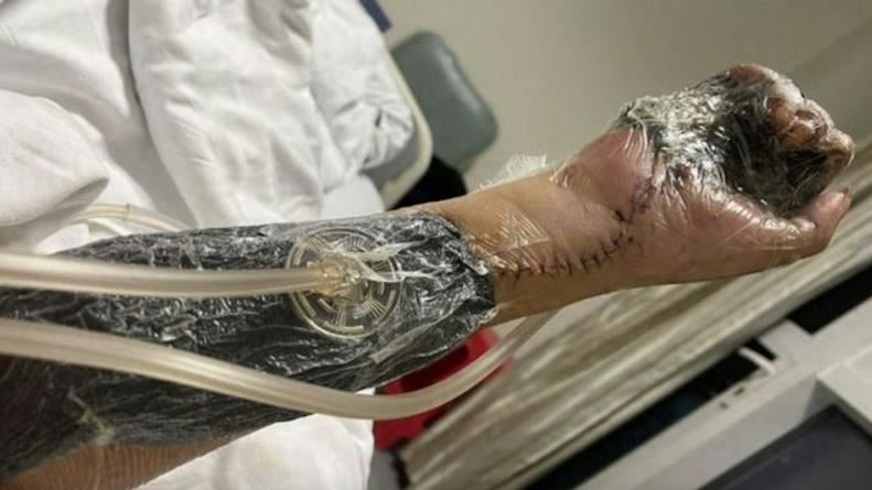 上班才6天誤觸輻射源　男右手萎縮潰爛