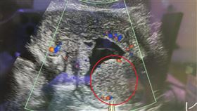 攝護腺超音波檢查可見肥大的攝護腺。（圖／烏日林新醫院提供）